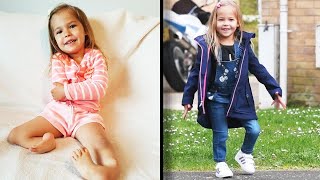 3YearOld Girl Born With Legs Bent Backward Is Now Walking [upl. by Martine]