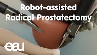 Robotassisted Radical Prostatectomy RARP [upl. by Arinayed]