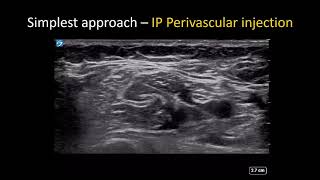 USguided Axillary Brachial Plexus Block  the Simple Guide [upl. by Adnamma]