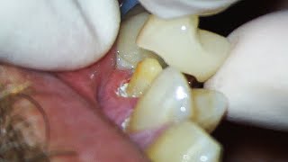 Dental Crown EXPLAINED and how much Tooth Youll Lose [upl. by Twum732]