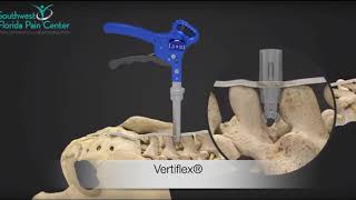 The Vertiflex® Procedure [upl. by Alick]