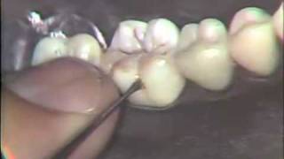 Class I Buccal Pit Cohesive Gold Foil [upl. by Ahserak]