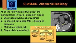 Benign adrenal tumors What You Need To Know [upl. by Chapman154]