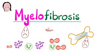 Primary Myelofibrosis PMF  Myeloproliferative Neoplasm  Bone Marrow Fibrosis [upl. by Angy862]