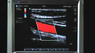 Sonosite MTurbo Product Training Part 2 Screen Layout [upl. by Anerrol706]