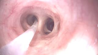 Mastering Bronchoscopy for Thoracic Surgery Chapter 1 [upl. by Trebmer13]