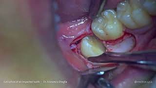 PIEZOSURGERY®  Dr Oreglia  Mandibular Impacted Third Molar Extraction with Piezo Technique [upl. by Amaris304]