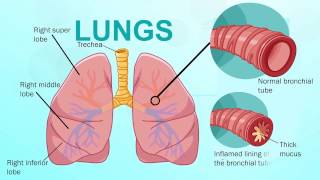 Chronic Bronchitis  Respiratory System [upl. by Novahs]