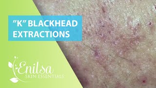 Blackheads Extractions “K’s” 7th Treatment [upl. by Ailaroc]