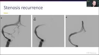 IIH Stenosis Recurrence amp Complications of Venous Sinus Stenting w Neurosurgeon Stephanie Chen MD [upl. by Nedroj406]