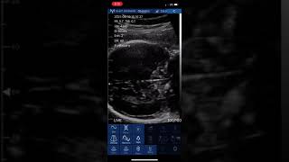 Five month fetus ultrasound with the EagleView probe [upl. by Mit]