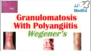 Granulomatosis with Polyangiitis Wegener’s granulomatosis  Symptoms Diagnosis Treatment [upl. by Nnairol]