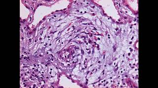 1 Indicaciones y manejo de biopsia renal [upl. by Eedebez175]