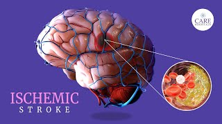 Diagnosis and Imaging in Acute and Chronic Limb Ischemia Jayer Chung MD [upl. by Allen528]