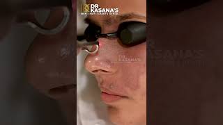 Birthmark Removal  Laser Permanent Birthmark Treatment  DrKasanas Clinic [upl. by Mitzie]