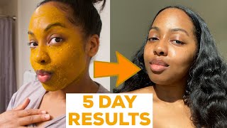 I DID A 5 DAY TURMERIC FACE MASK amp This Happened  MISS C Beauty [upl. by Arnold]