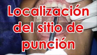 Tecnicas de anestesia en odontologia [upl. by Duax]