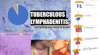 Tuberculous lymphadenitis  stages of cervical lymphadenitis  cold abscess  collar stud abscess [upl. by Nirre]