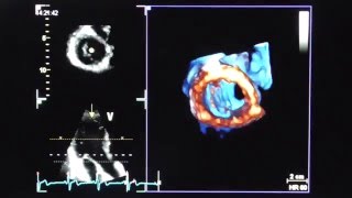 4D Echokardiographie Mitralklappe 4D Echocardiography mitral valve [upl. by Horatius758]