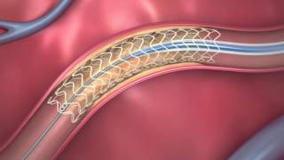 Brain Stents Show Promise for Stroke Patients [upl. by Ennoirb]