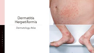 Dermatitis Herpetiformis [upl. by Suoicserp996]