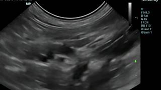 Small Animal Ultrasound  Diaphragmatic Hernia [upl. by Durrej751]