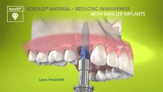 Straumann® Bone Level Tapered Implant [upl. by Nnorahs]