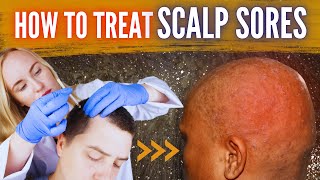 How To Treat Scalp Sores [upl. by Arrakat]