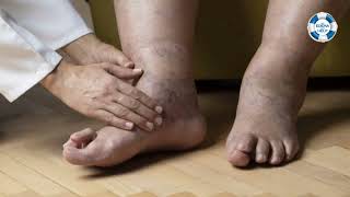 Know About Pedal Edema Causes Symptoms amp Treatment By Nephrologist Dr Himadri Shankar [upl. by Alicec]