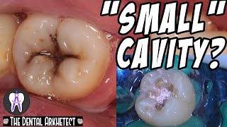 Restoring A Tooth Back To Its Original Shape C17 [upl. by Blunt]