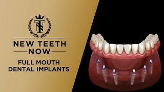 Full Mouth Dental Implant Procedure [upl. by Yelyak]