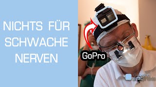 Zahnarzt filmt Weisheitszahn OP mit GoPro Vollnarkose [upl. by Hoehne]