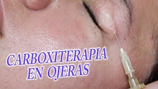 Eliminar ojeras con Carboxiterapia tratamiento medico [upl. by Inaej]