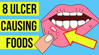 8 FOODS and DRINKS causing MOUTH ULCERS Canker sore  Plus treatment [upl. by Ingrim257]