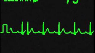 1st Degree AV Block  ECG Simulator  Arrhythmia Simulator [upl. by Ayirp]