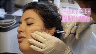 Voluma Cheek Fillers Before amp After Vlog  Solange Nicole [upl. by Nnylkcaj453]