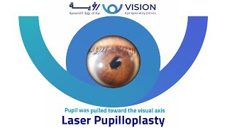 Laser pupilloplasty for updrawn pupil HM to 636 immediately postop [upl. by Wakerly554]