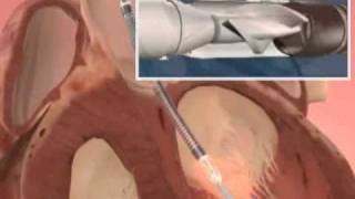 The Impella Device for Heart Failure [upl. by Obala82]