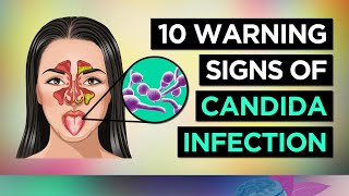 10 Symptoms of CANDIDA OVERGROWTH Yeast Infection [upl. by Humble]