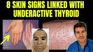 Doctor explains 8 SKIN SIGNS linked with HYPOTHYROIDISM aka underactive thyroid [upl. by Ilah]