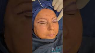 Blefaroplastia Cirugía de parpados [upl. by Nohsyar671]