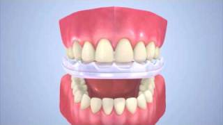 Custom Comfort Dental Guard [upl. by Assyl]