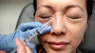 Mole removal Radiofrequency audiowmv [upl. by Dorran325]