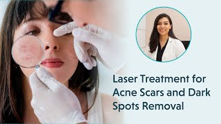 Laser Treatment for Acne Scars  Laser Treatment for Dark Spots Removal [upl. by Gerhardine319]