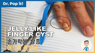 Removing a jellylike finger cyst digital mucous cyst  Dr Pop It [upl. by Freida]