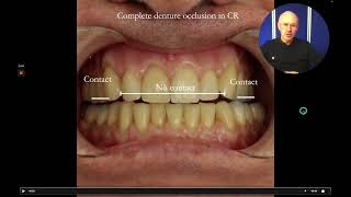 Biting and new complete dentures – the sandwich filling Blog 71 denture occlusion in CR [upl. by Enelrahs]