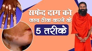 सफेद दाग White Spots को जल्द ठीक करने के 5 तरीके  Swami Ramdev [upl. by Asira197]