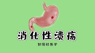 医学手绘动漫胃肠溃疡的治疗 treatment of peptic ulcer [upl. by Hildick]