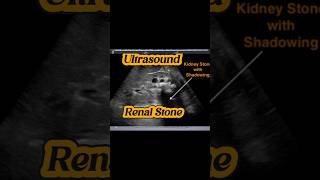 Renal Stones  Ureteric VUJ Stone  Hydronephrosis Hydroureter Ultrasound [upl. by Nomyaw]