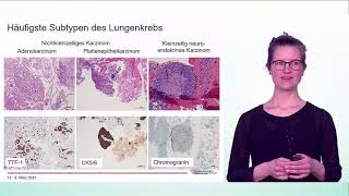 Tumordiagnstik durch die Pathologie an kleinsten Gewebsstückchen  Dr Hannah Füllgraf [upl. by Giffer392]